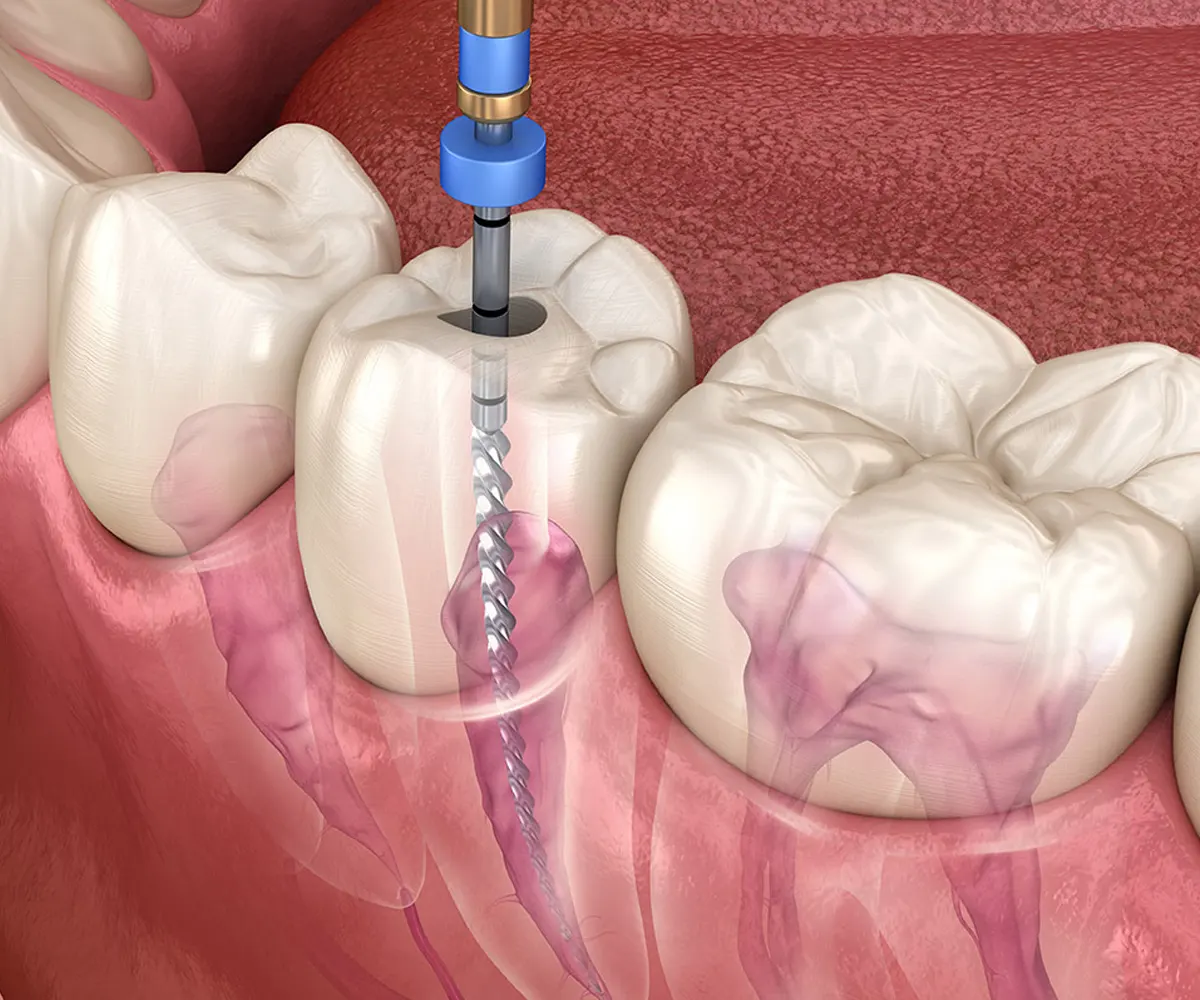 Root Canal Treatment (Single Sitting RCT)