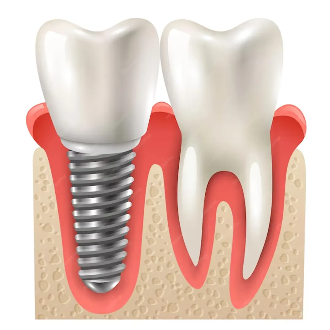 Smile Renewed: The Advantages of Dental Implants