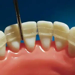 Mobile Teeth Treatment