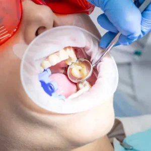 Root Canal Treatment (Single Setting RCT)