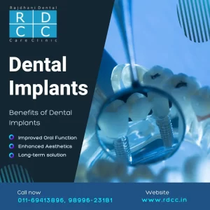 Best Dental Implants in Preet Vihar