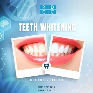 Achieve a Bright Smile with Rajdhani Dental Care: Teeth Whitening in Preet Vihar